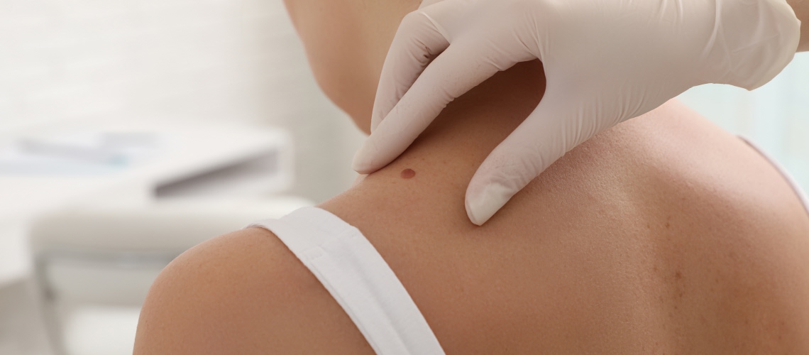 Skin cancer screening and mole examination at Integrated Dermatology of Glens Falls, NY
