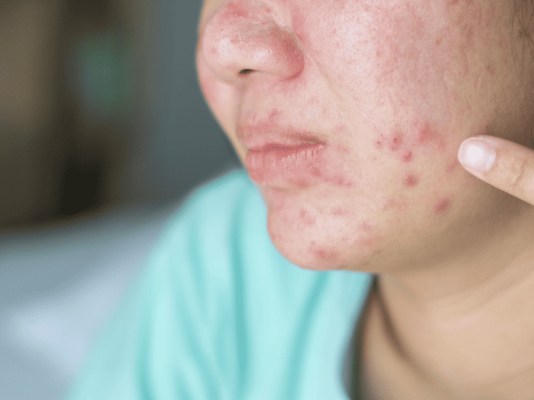 Acne Treatment & Care