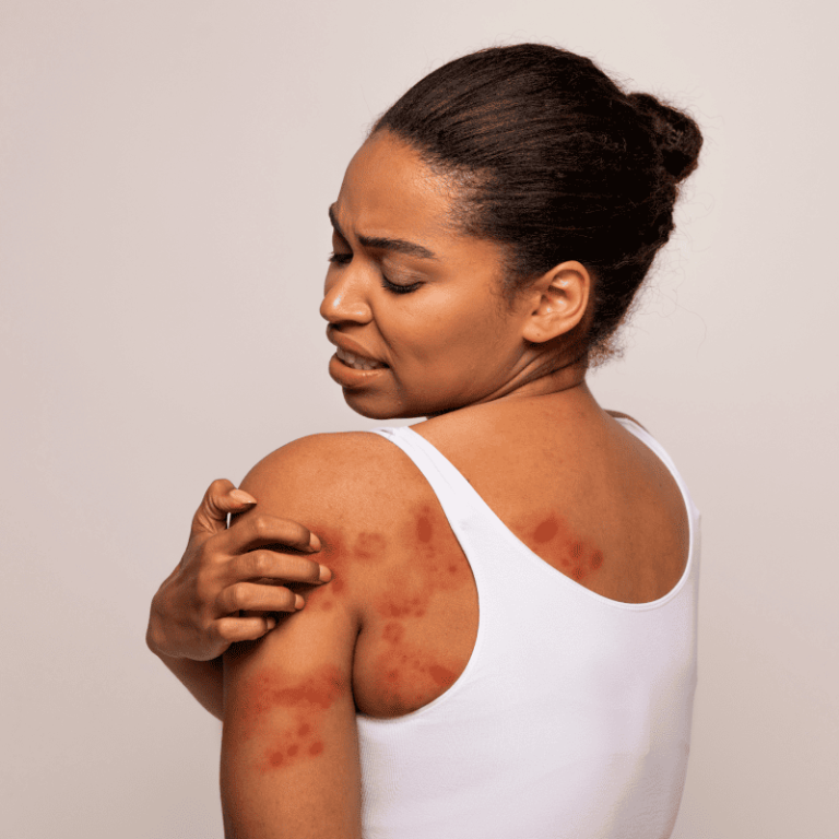 Eczema Care