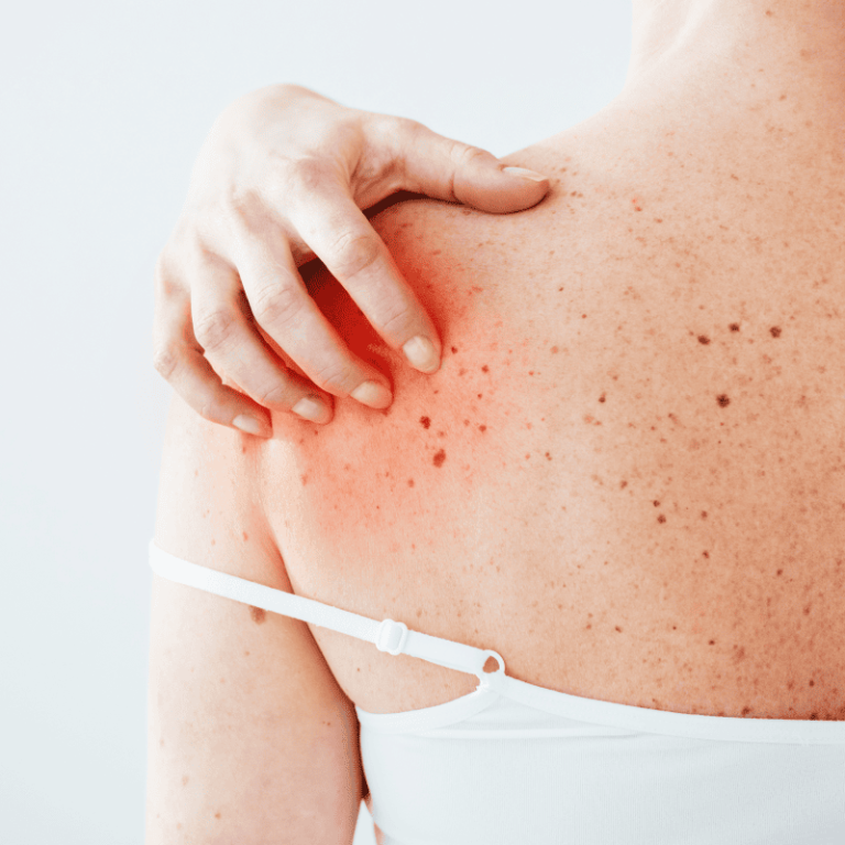 Rashes