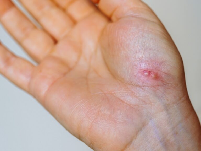Warts & Wart Removal
